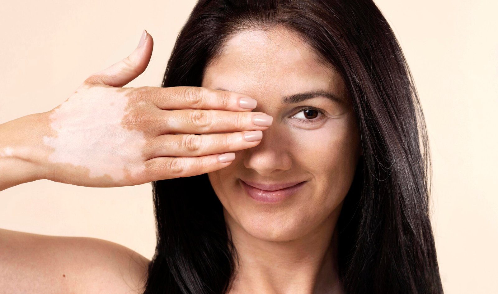 Vitiligo tem cura? Entenda o que diz a ciência e como tratar com segurança