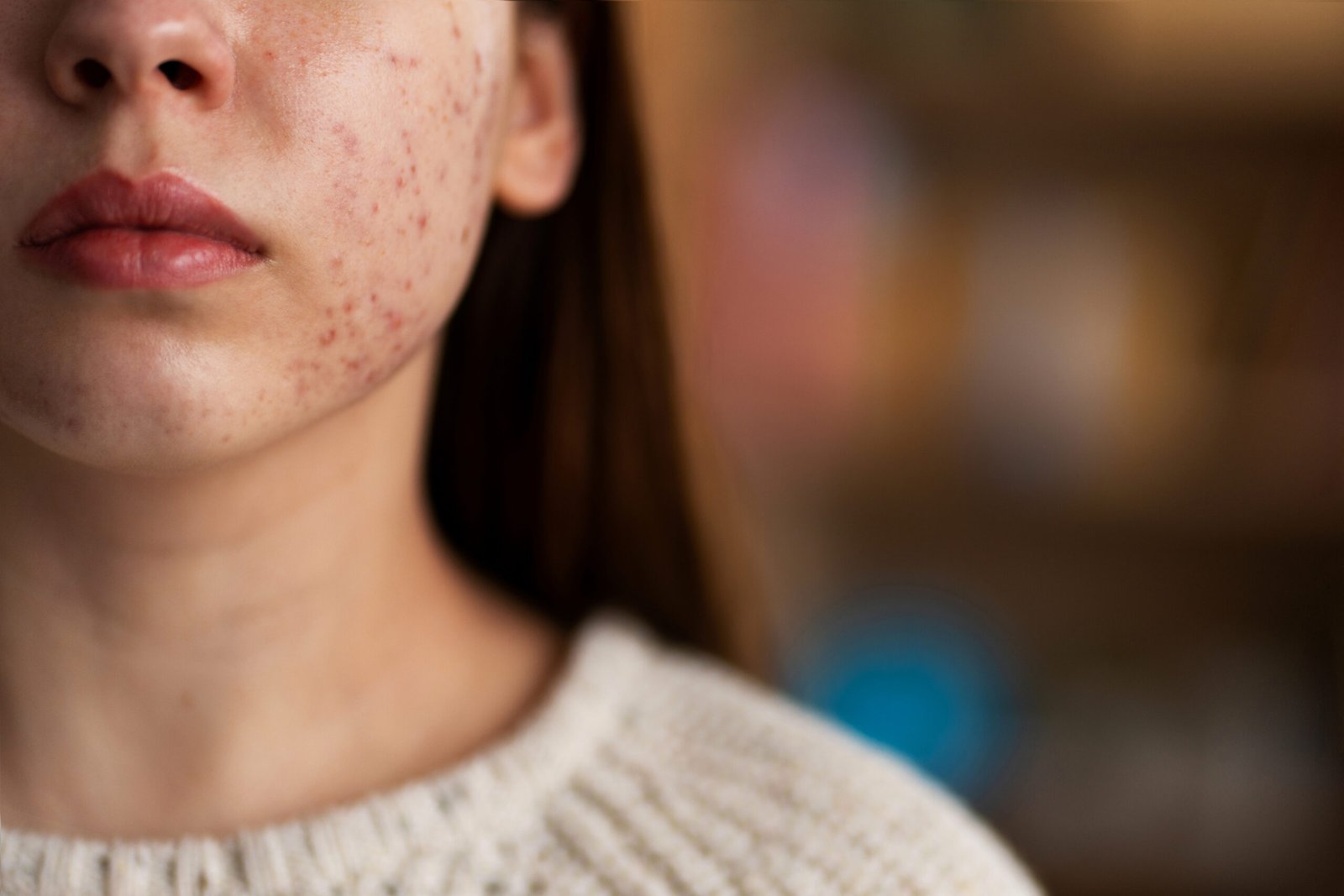 Espironolactona: como essa medicação atua no tratamento da acne e queda de cabelo feminina