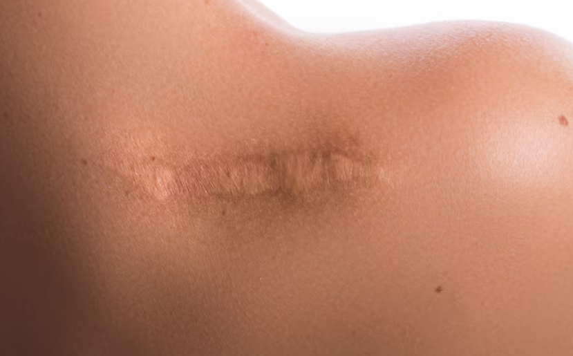 Cicatriz hipertrófica: Como tratar e suavizar marcas com tecnologia avançada