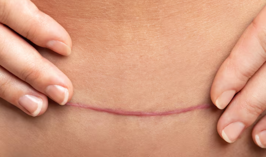 Queloide: como tirar de forma eficaz? Entenda os tratamentos e a ciência por trás