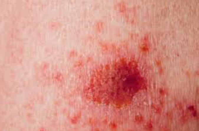 Pintas vermelhas na pele: entenda as causas e saiba quando procurar um médico