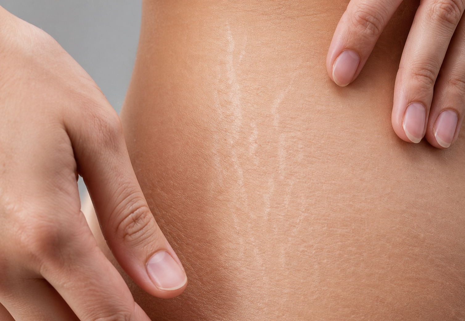 Estrias Brancas: Como Tratar e Suavizar Marcas com o Laser Fotona