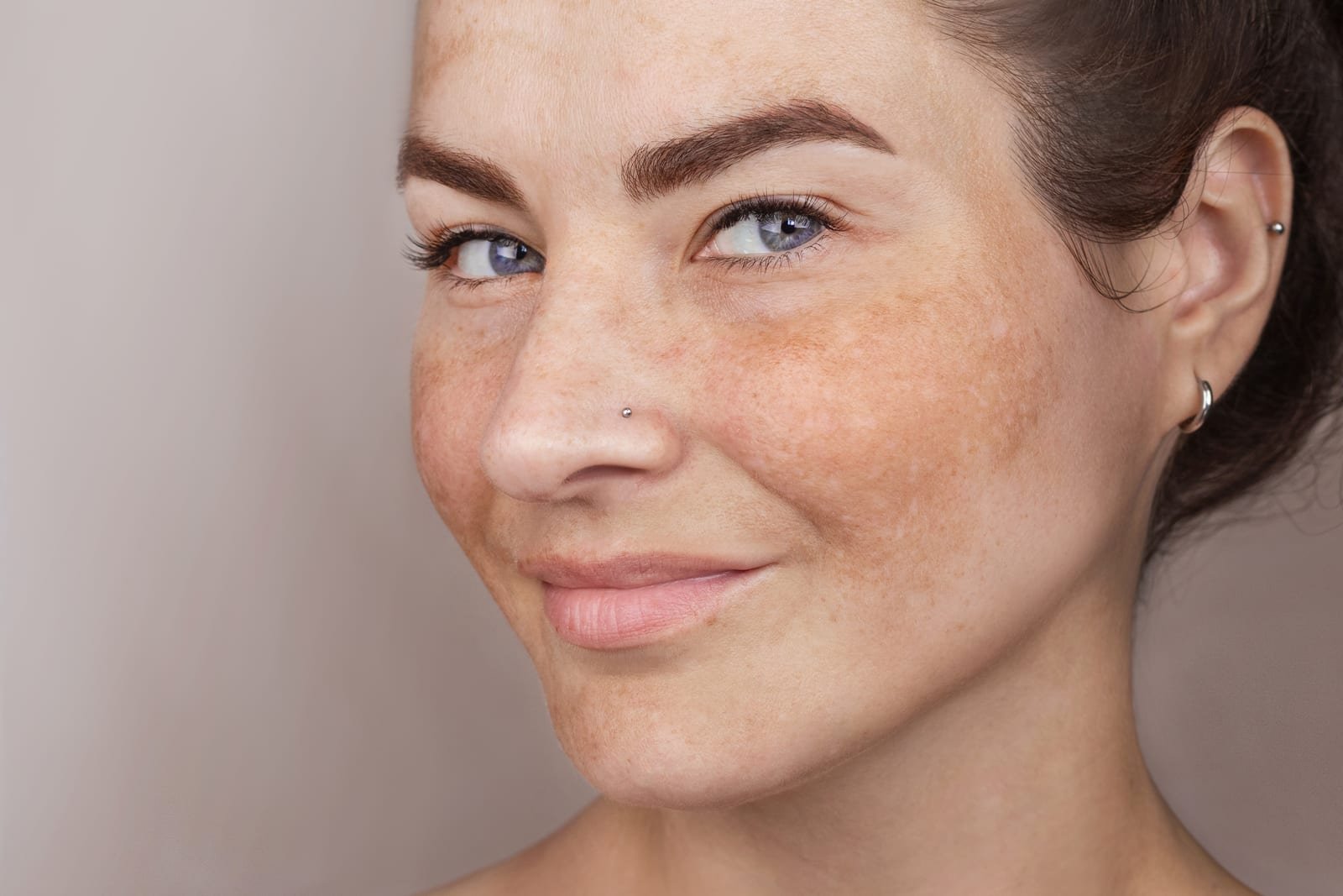 Ácido Tranexâmico no Melasma: Como Funciona e Quando Usar