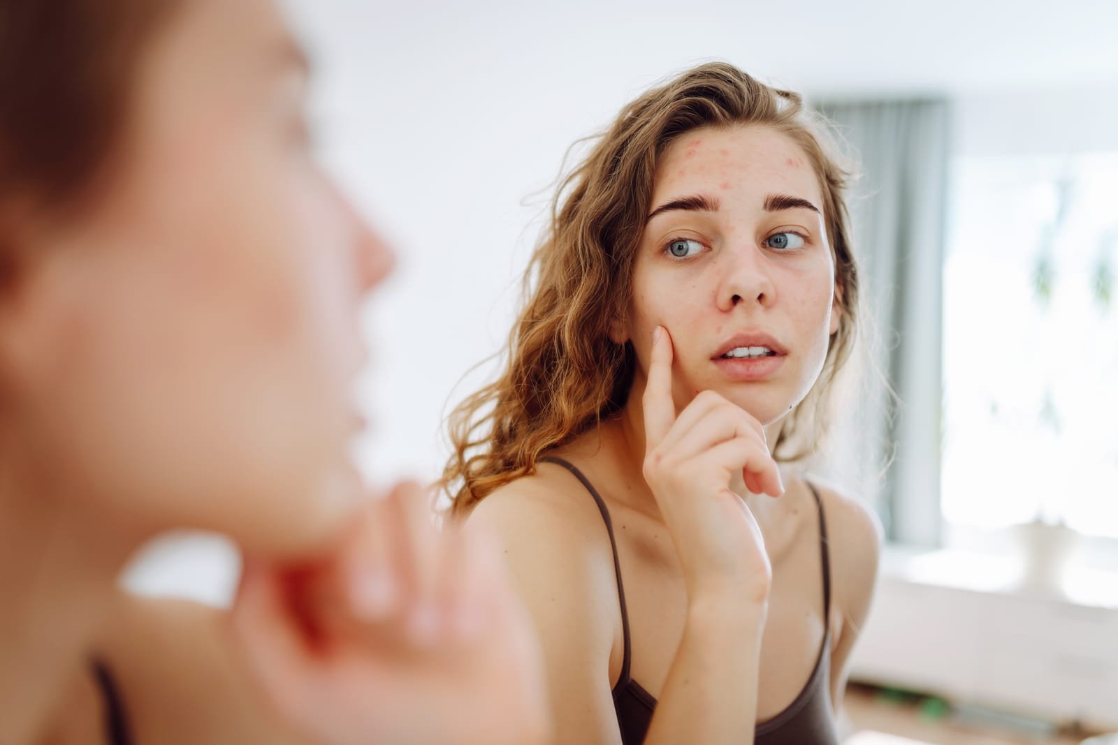 Detalhe da pele do queixo e da mandíbula, região típica da acne hormonal