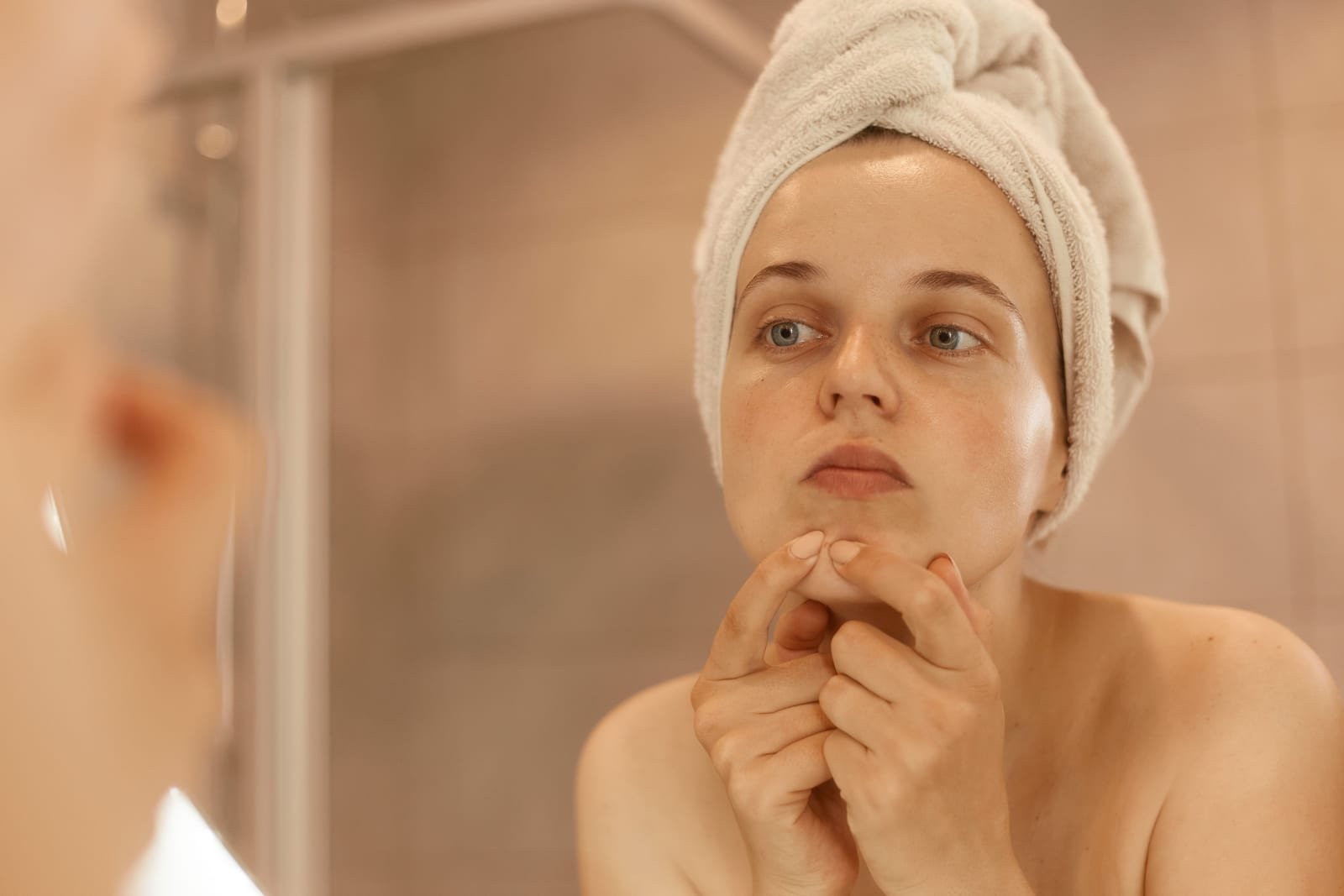 Acne Hormonal na Mulher Adulta: Por Que Surge e Como Tratar