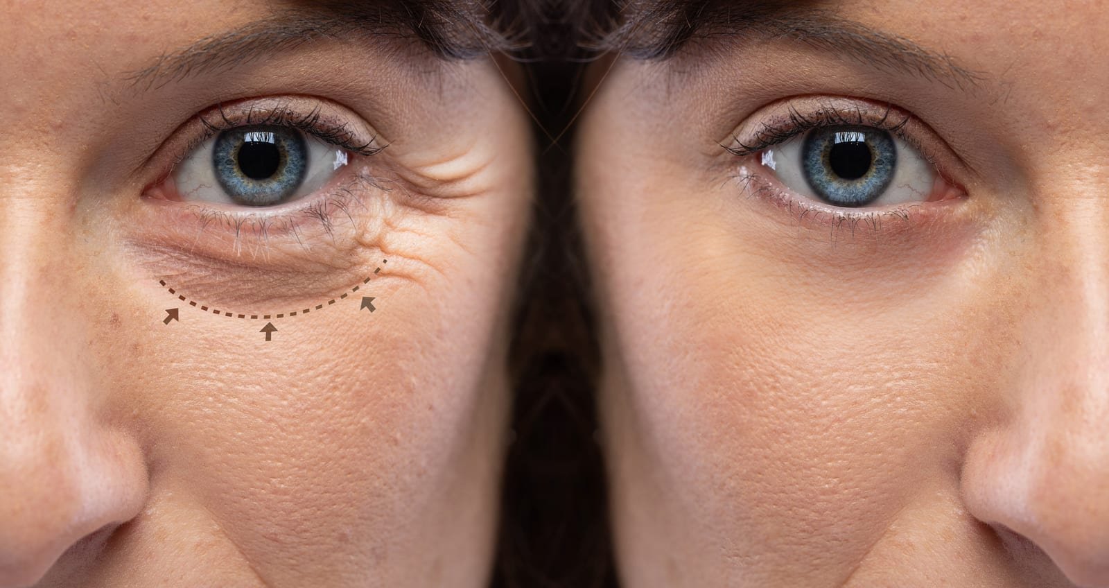 Avaliação para blefaroplastia, cirurgia das pálpebras que deixa o olhar mais descansado