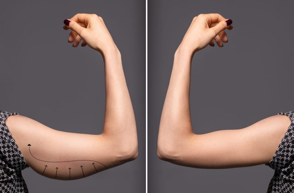 Braquioplastia (Lifting de Braço)