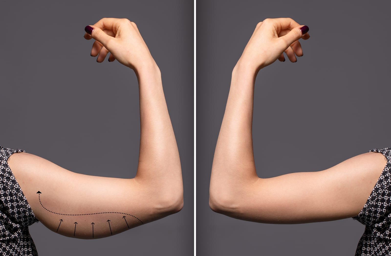Avaliação para braquioplastia, cirurgia de lifting de braço que corrige a flacidez