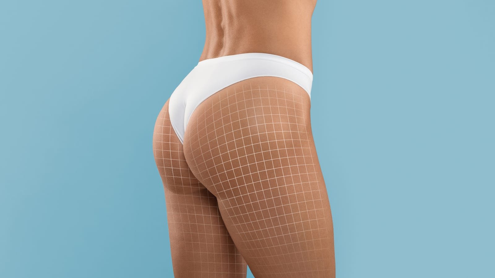 Avaliação para gluteoplastia, cirurgia que melhora a forma e o contorno dos glúteos