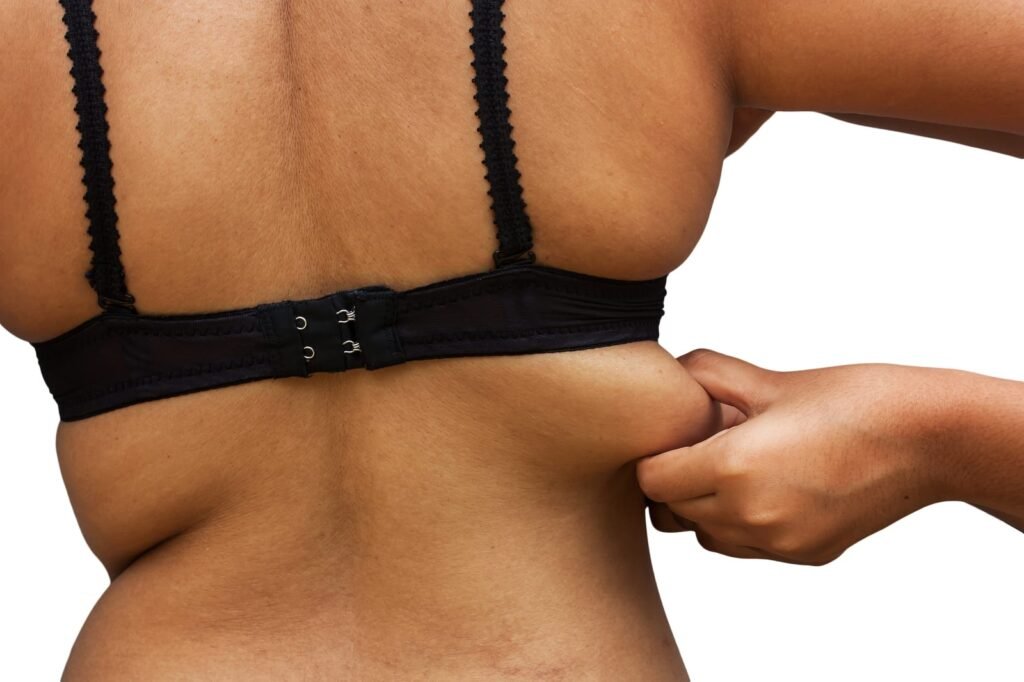 Torsoplastia (Body Lift)