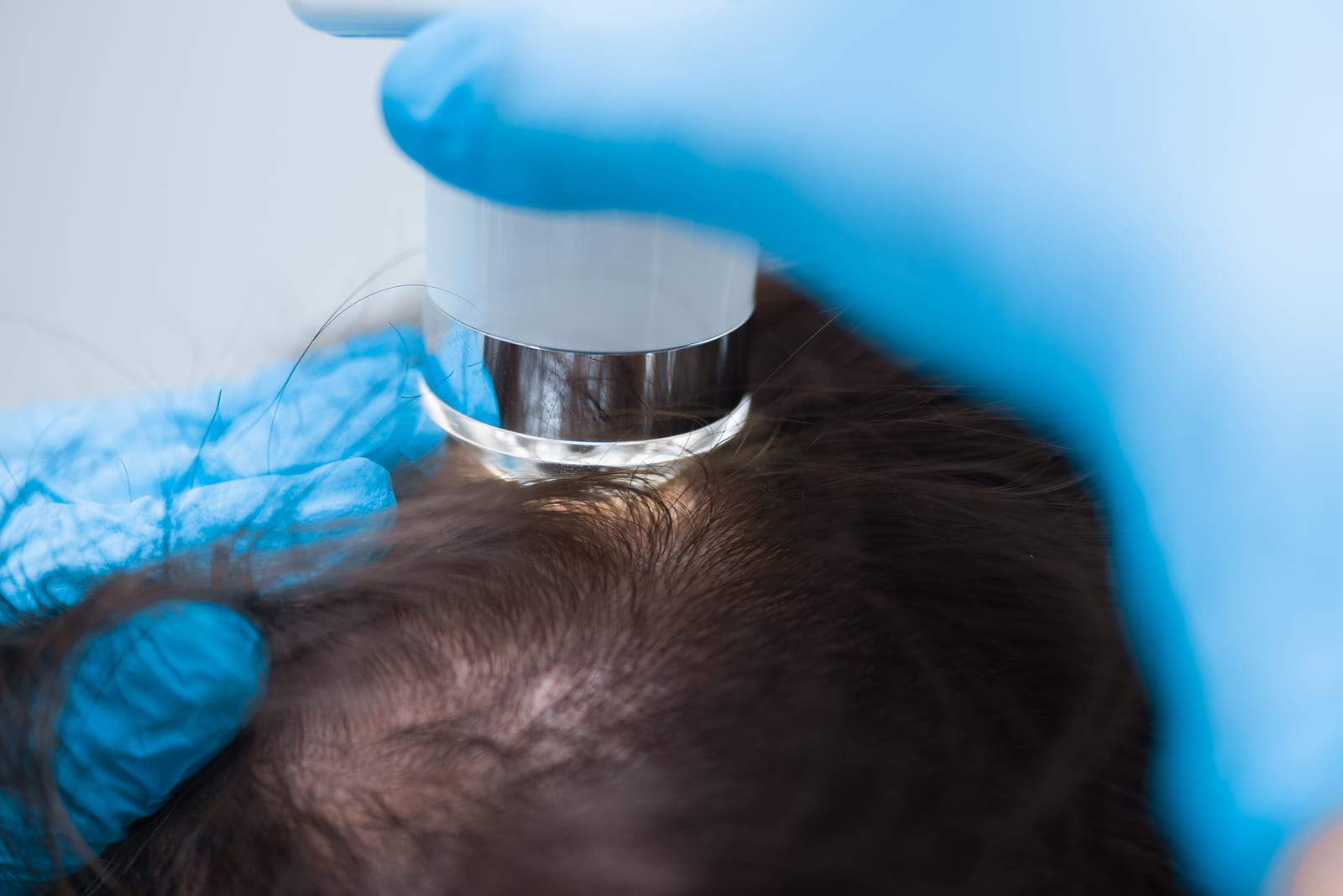Exossomos para queda de cabelo: avaliação do couro cabeludo em consulta dermatológica