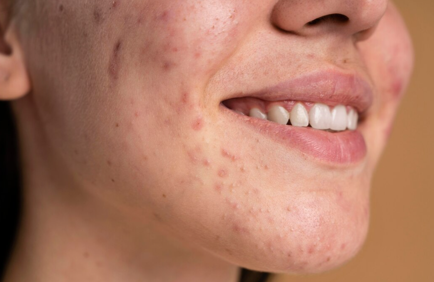 Acne na pele: Entenda as Causas e as Soluções Médicas Modernas