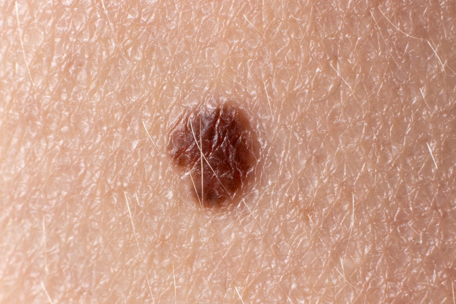 O que é um melanoma: sintomas, diagnóstico e tratamento precoce
