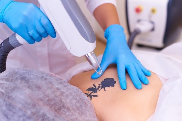 Remoção de tatuagem a laser em consultório dermatológico