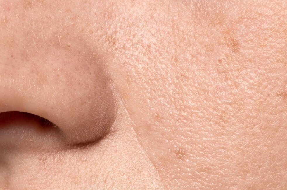 Poros Dilatados: Sinais de Alerta e Quando Agir — Skincare: O Que Ajuda e O Que Piora