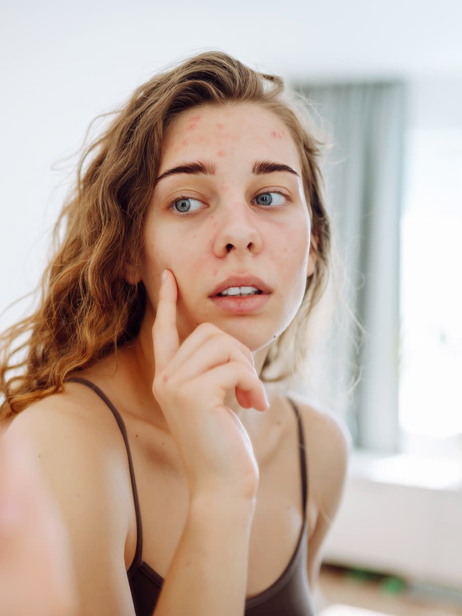 Mulher adulta observando a pele com acne no espelho