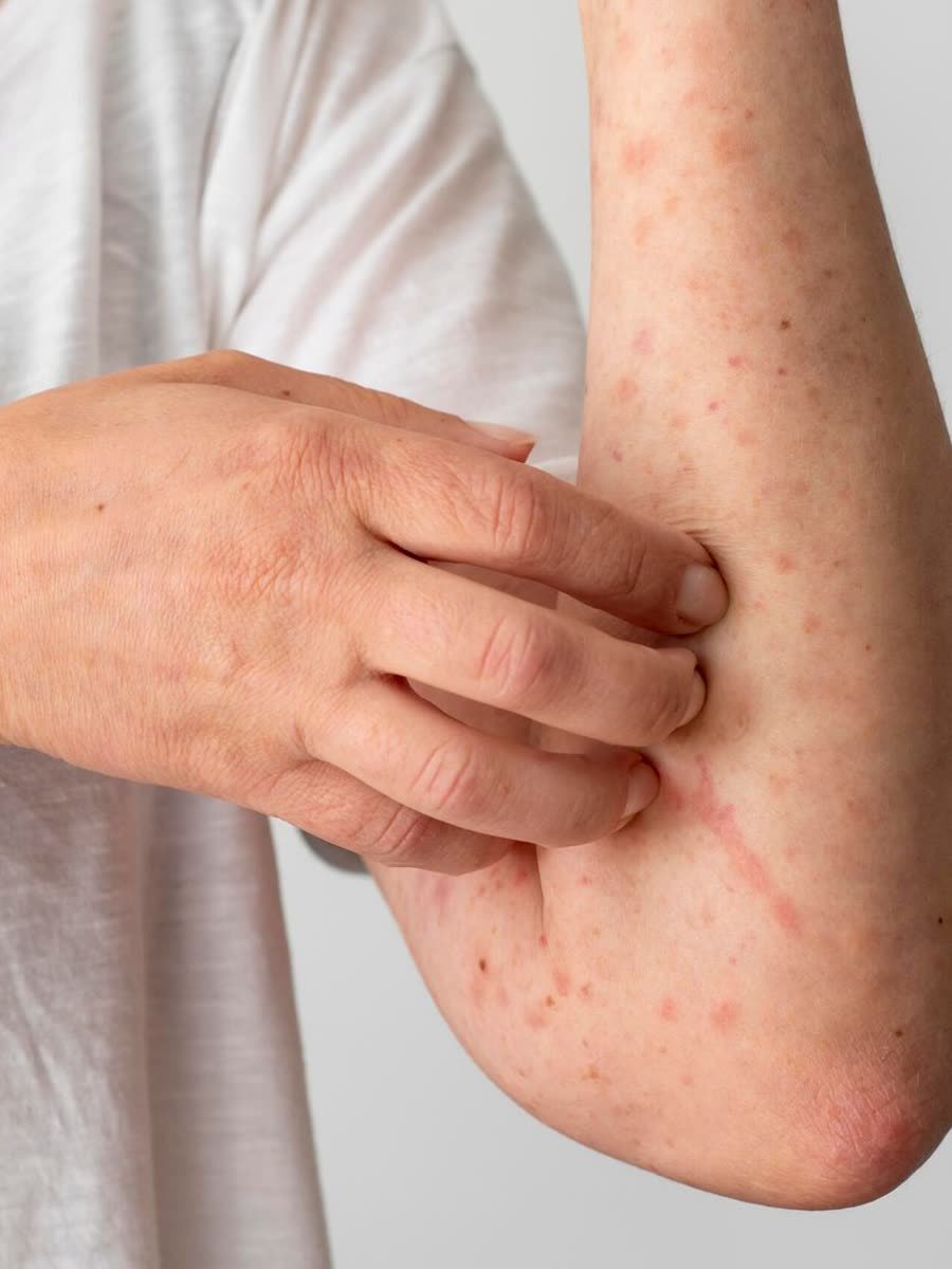 Coceira e vermelhidão no braço por dermatite atópica