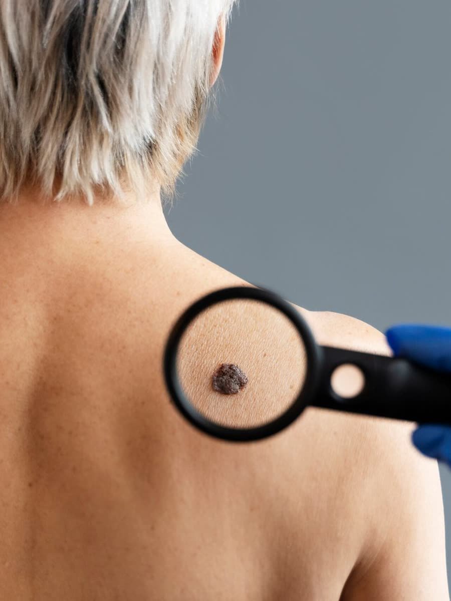 Dermatologista examinando pintas nas costas com dermatoscópio