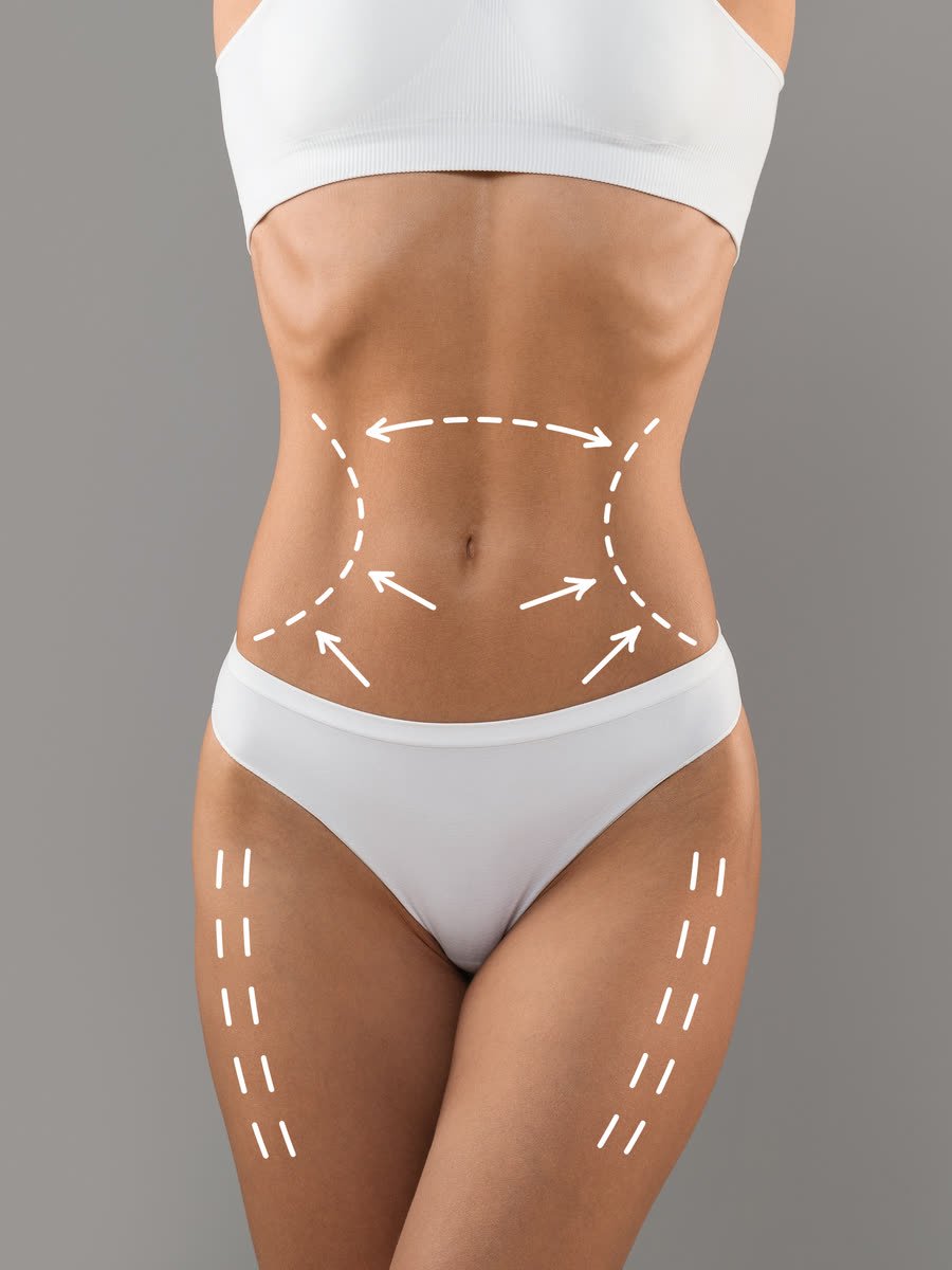 Planejamento de abdominoplastia