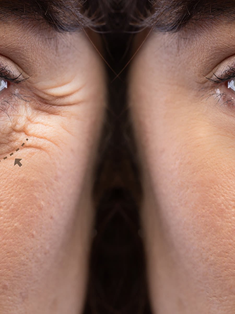 Marcação para blefaroplastia na região dos olhos