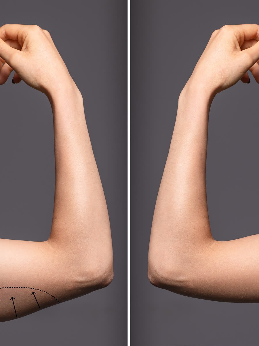 Avaliação dos braços para braquioplastia