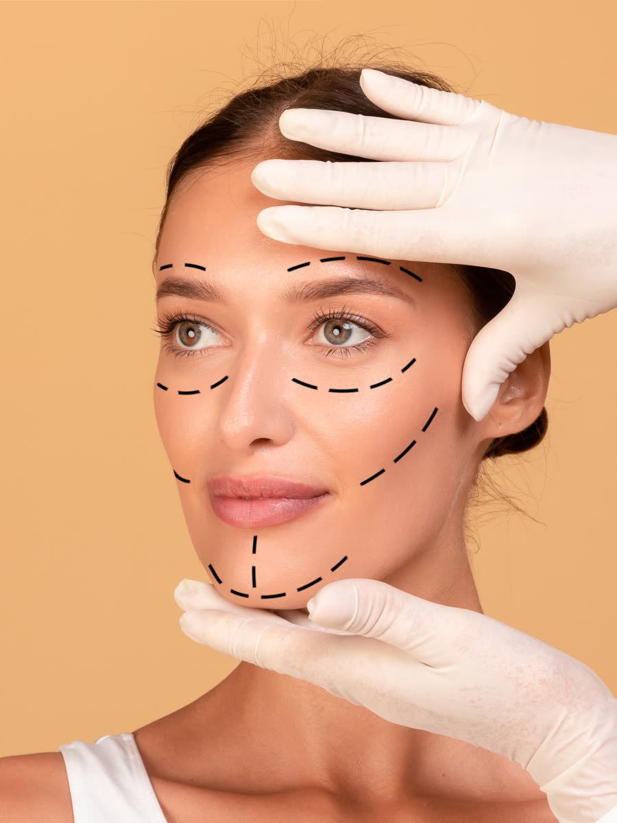 Marcação para lifting facial