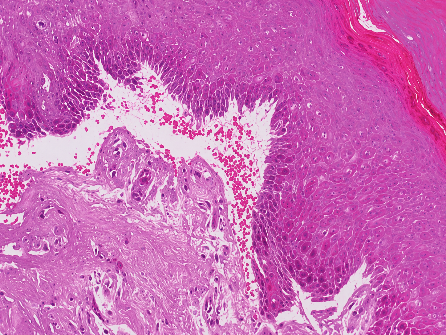 Porfiria cutânea tardia: o que é e por que causa bolhas na pele? — Quando procurar avaliação dermatológica