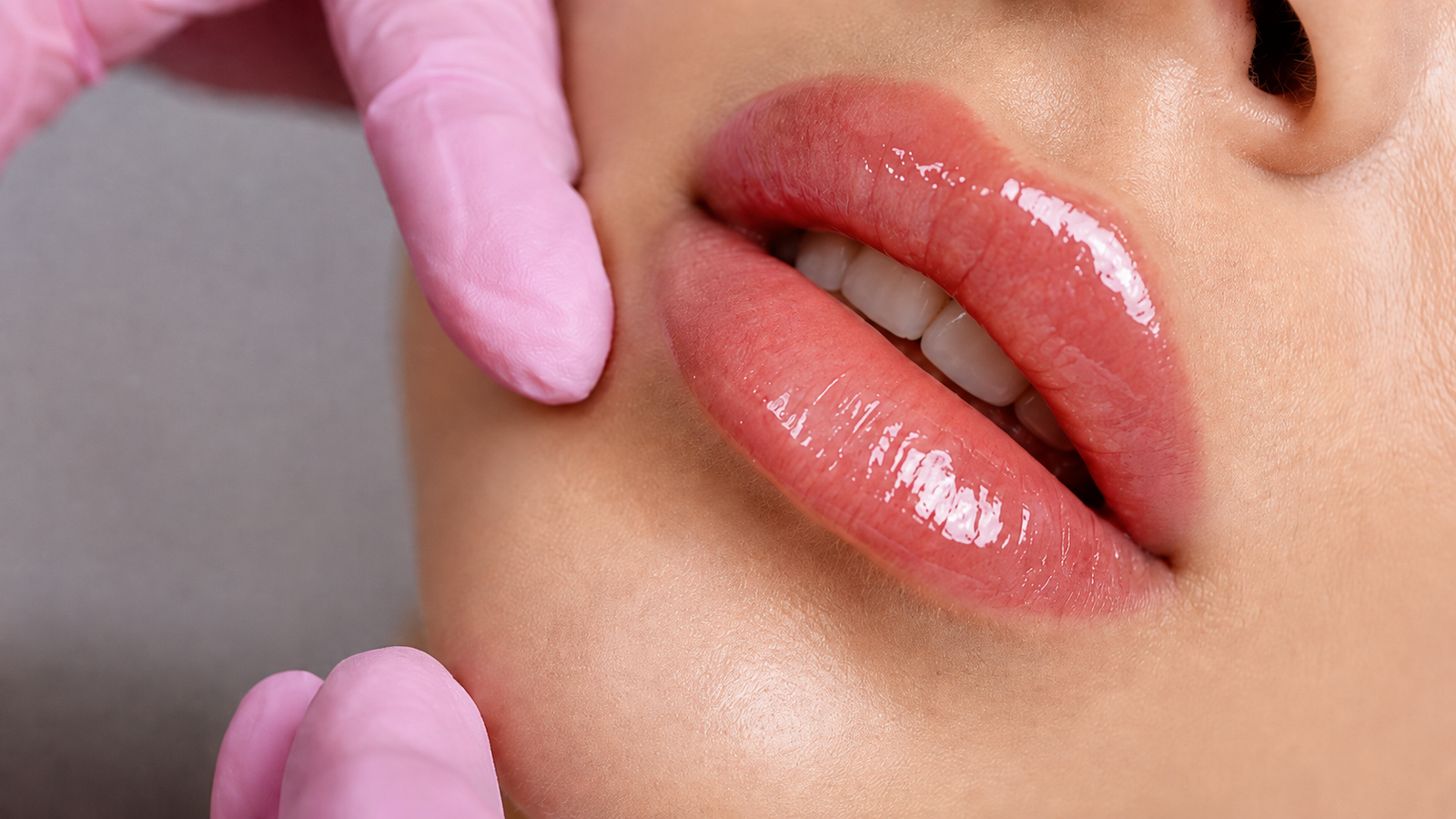 Volume labial sem preenchimento: conheça o Liplase para realçar os lábios com naturalidade — Para quem o Liplase é indicado